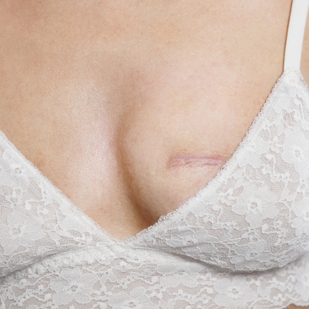 Post-mastectomy scar